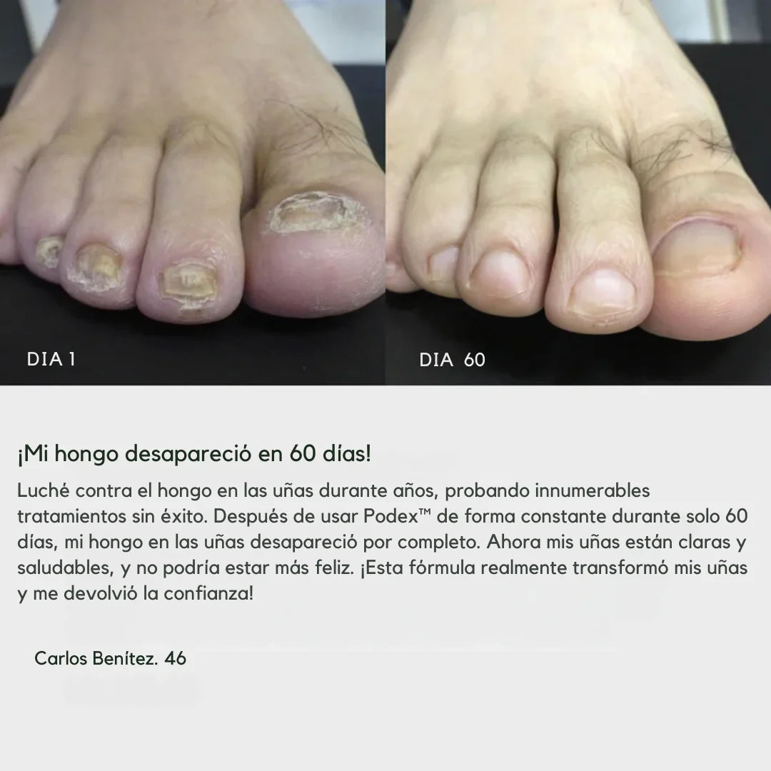 Podex™ – Uñas sanas y sin vergüenza en 21 días. PACK 2x1