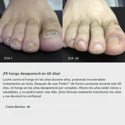 Podex™ – Uñas sanas y sin vergüenza en 21 días. PACK 2x1